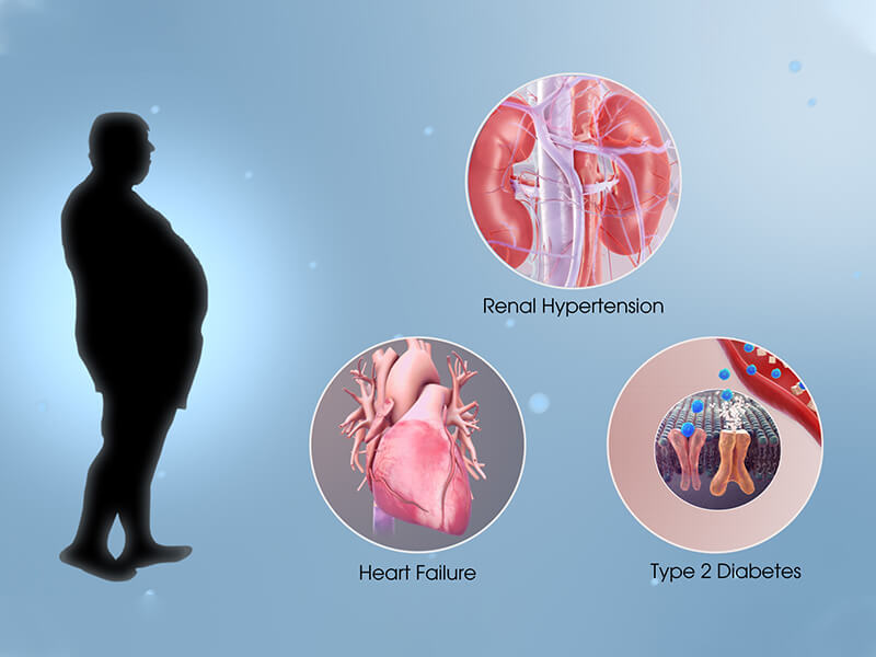 سندروم متابولیک