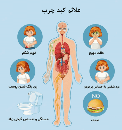 علائم کبد چرب دکتر سپهری